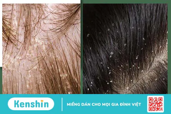 Gàu ướt: Nguyên nhân phát sinh và cách trị tận gốc 2