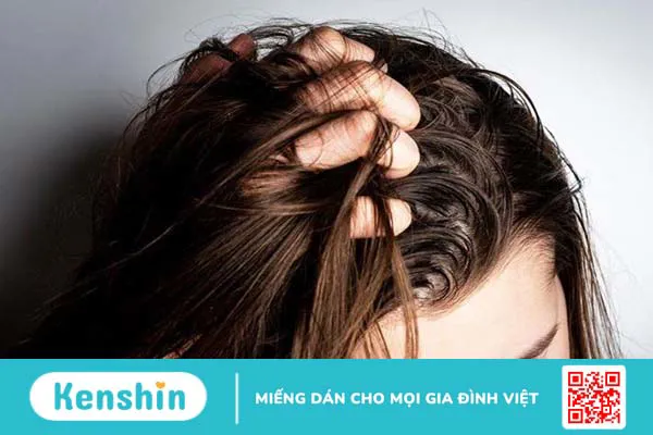 Gàu ướt: Nguyên nhân phát sinh và cách trị tận gốc 3