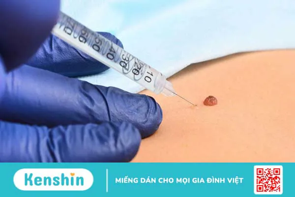 Gây tê cục bộ: Khái niệm, trường hợp sử dụng và tác dụng phụ 1