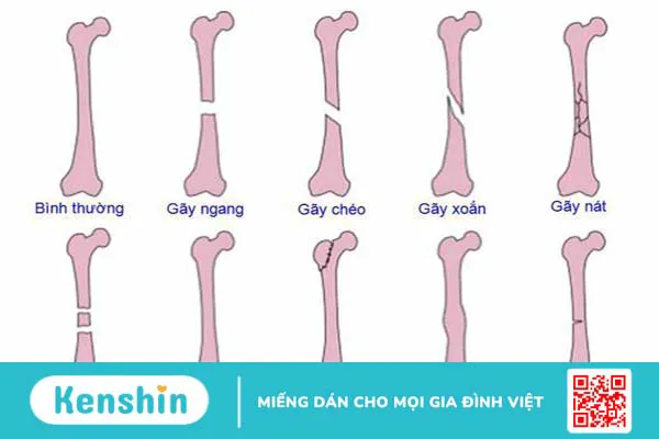 Tìm hiểu về gãy xương kín1