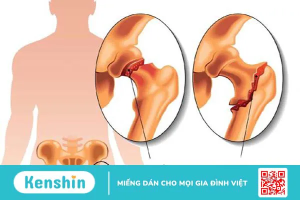 Tìm hiểu về gãy xương kín2