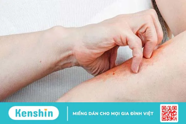 Ghẻ nước là bệnh gì? Bệnh ghẻ nước có lây không 2