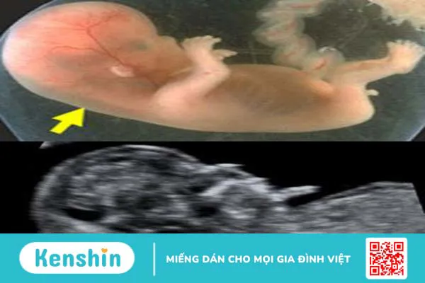 Độ mờ da gáy 1.0mm có bình thường không? 2