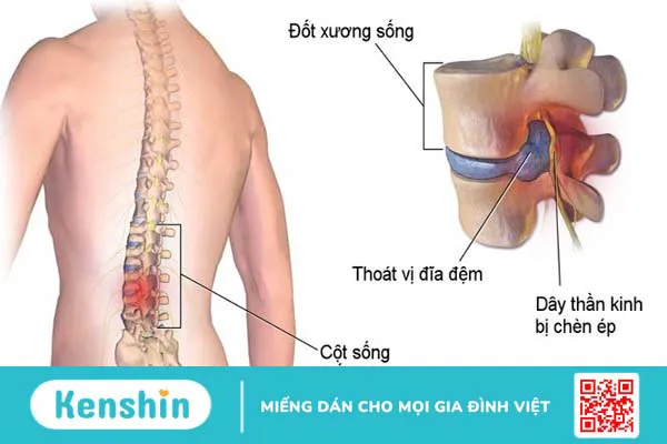 Giải đáp thắc mắc thoát vị đĩa đệm có nên đạp xe không? 1