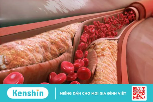 Giải đáp thắc mắc: Xét nghiệm cholesterol toàn phần là gì?