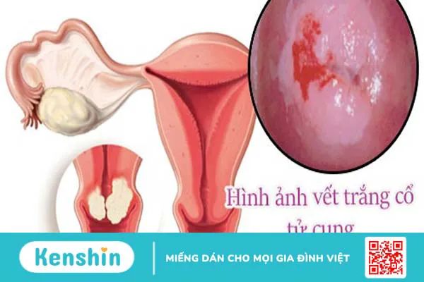 Vết trắng cổ tử cung có phải ung thư không? 1