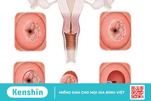 Vết trắng cổ tử cung có phải ung thư không? 2