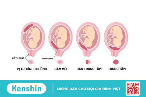 Gợi ý mẹ bầu tư thế nằm khi bị nhau tiền đạo 1