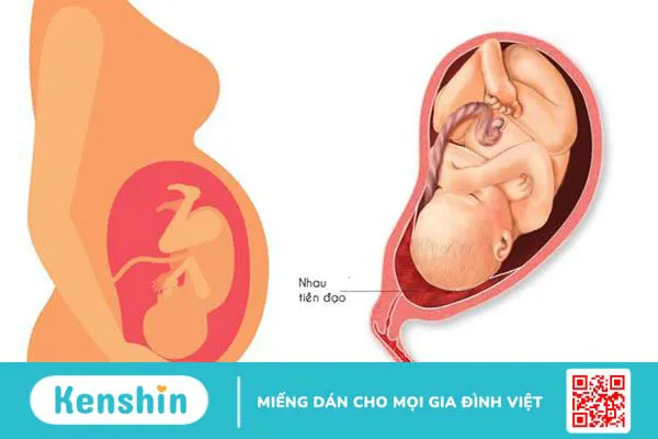 Gợi ý mẹ bầu tư thế nằm khi bị nhau tiền đạo 2