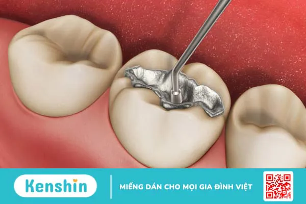 Hàn răng giá bao nhiêu? Những điều cần biết về phương pháp hàn răng 1