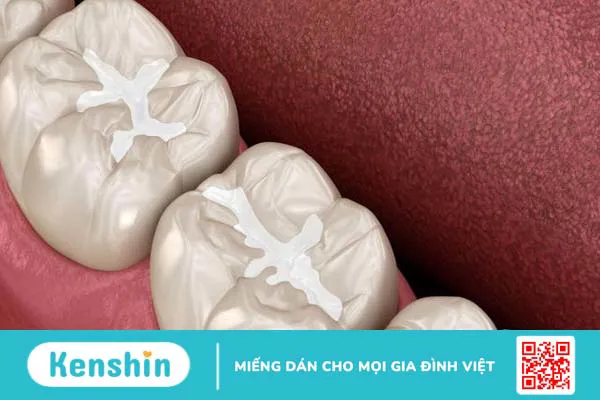 Hàn răng giá bao nhiêu? Những điều cần biết về phương pháp hàn răng 4