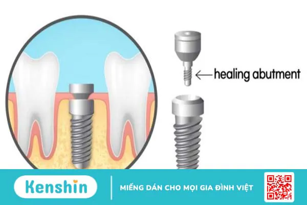 Healing implant là gì? Các đặc điểm nổi bật 1