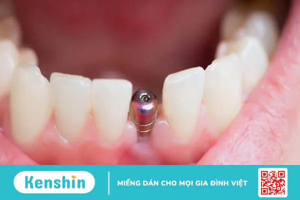 Healing implant là gì? Các đặc điểm nổi bật 2