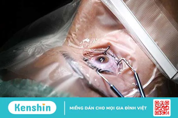 Mắt nhìn thấy đốm đen là bệnh gì? 4