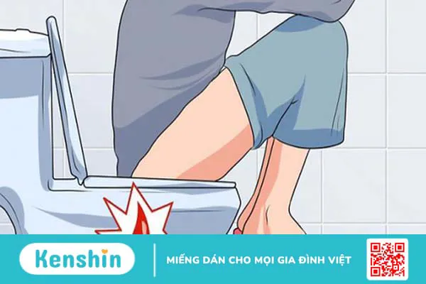 Hình ảnh bệnh trĩ nội và bệnh trĩ ngoại theo 4 cấp độ 7