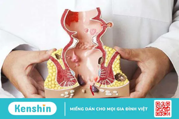 Hình ảnh bệnh trĩ nội và bệnh trĩ ngoại theo 4 cấp độ 2