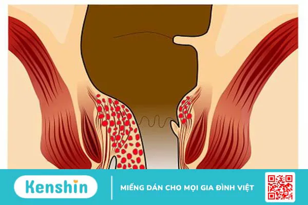 Hình ảnh bệnh trĩ nội và bệnh trĩ ngoại theo 4 cấp độ 3