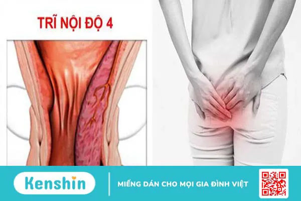 Hình ảnh bệnh trĩ nội và bệnh trĩ ngoại theo 4 cấp độ 4