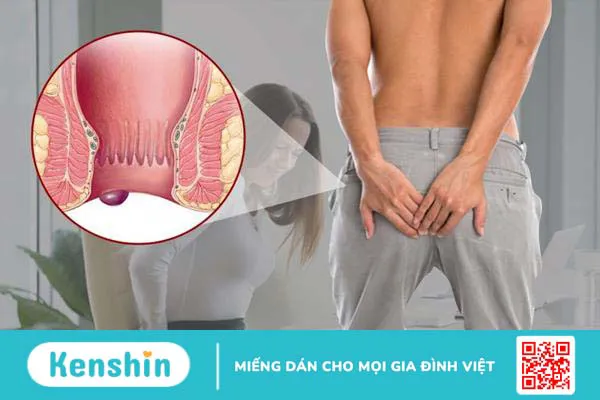 Hình ảnh bệnh trĩ nội và bệnh trĩ ngoại theo 4 cấp độ 5