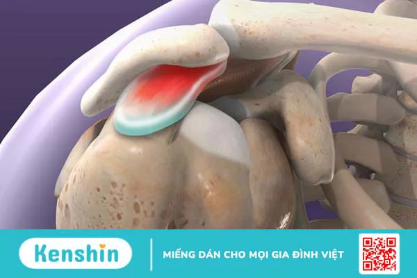 Hội chứng chèn ép khoang dưới mỏm cùng vai và những điều cần biết 1