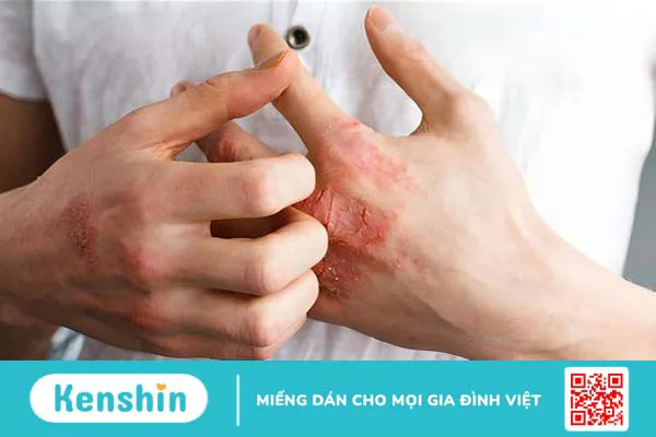 Hội chứng đỏ đau đầu chi: Nguyên nhân, triệu chứng và biện pháp chẩn đoán, điều trị bệnh 2