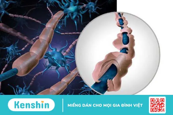 Hội chứng Guillain - Barre (GBS) là gì?  Dấu hiệu nhận biết bệnh thế nào? 1