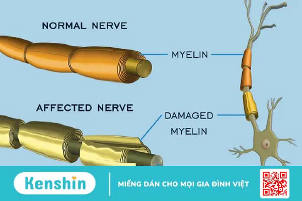 Hội chứng Guillain - Barre (GBS) là gì?  Dấu hiệu nhận biết bệnh thế nào? 2