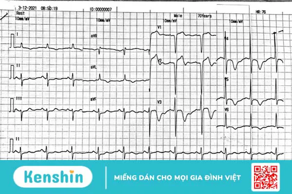 Hội chứng khoảng QT ngắn do nguyên nhân gì? Cách chẩn đoán và điều trị 3