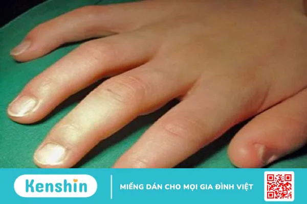 Hội chứng móng và xương bánh chè: Nguyên nhân, triệu chứng, chẩn đoán và điều trị 2