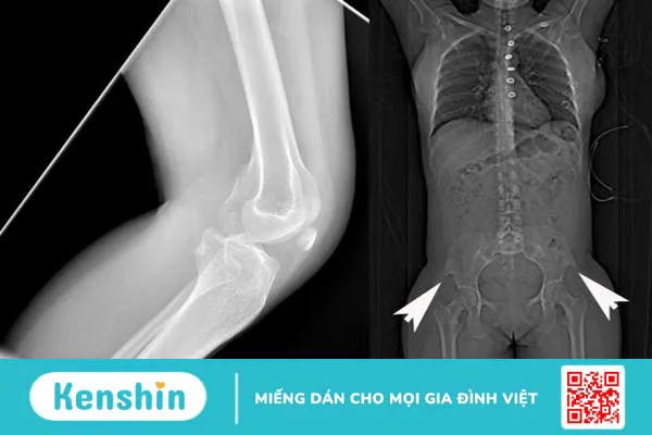 Hội chứng móng và xương bánh chè: Nguyên nhân, triệu chứng, chẩn đoán và điều trị 3