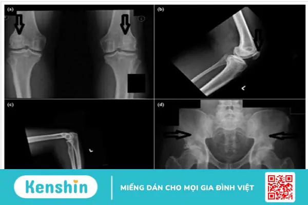 Hội chứng móng và xương bánh chè: Nguyên nhân, triệu chứng, chẩn đoán và điều trị 4