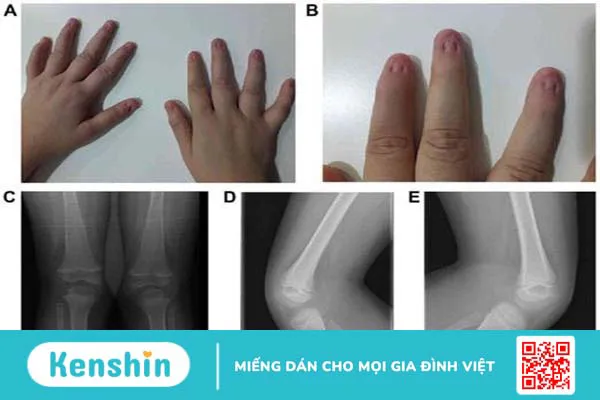 Hội chứng móng - xương bánh chè là thế nào? Các dấu hiệu nhận biết bệnh 1