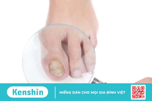 Hội chứng móng - xương bánh chè là thế nào? Các dấu hiệu nhận biết bệnh 3