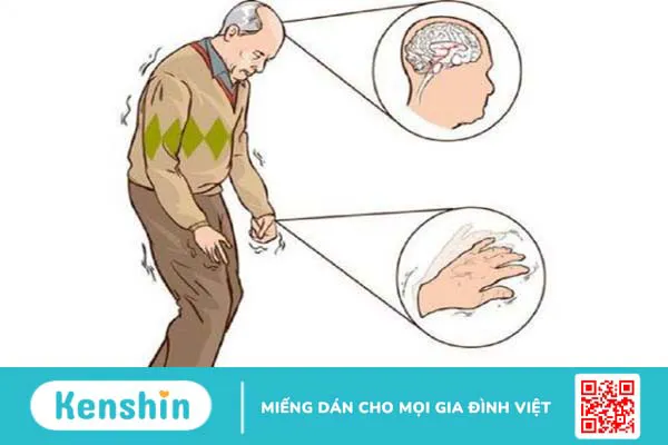 Nguyên nhân và biểu hiện của hội chứng Parkinson thứ phát và không điển hình 2