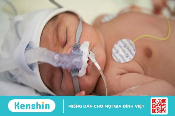 Hội chứng phổi ướt ở trẻ sơ sinh là bệnh gì? Có nguy hiểm không 3