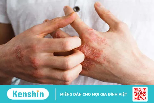 Hội chứng Sézary là bệnh gì? Có nguy hiểm không 1