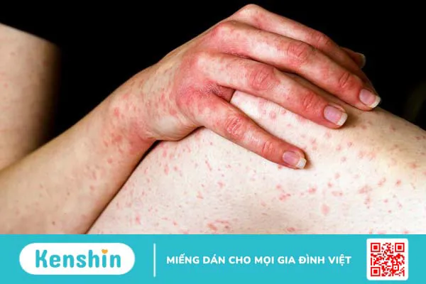 Hội chứng Sézary là bệnh gì? Có nguy hiểm không 2