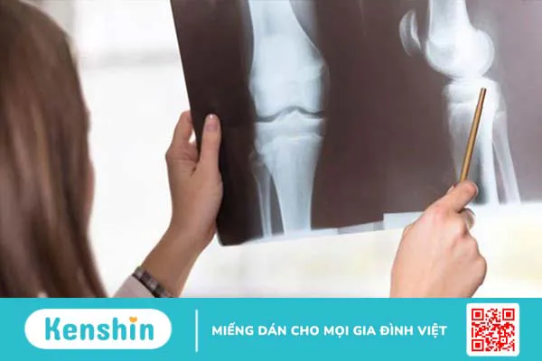 Hội chứng Sinding-Larsen-Johansson là bệnh gì? Điều trị như thế nào 3