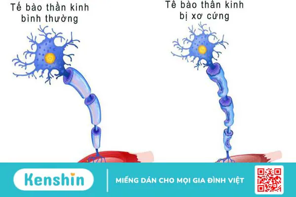 Hội chứng xơ cứng teo cơ một bên và những điều bạn cần biết 2