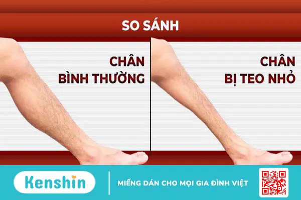 Hướng dẫn 6 bài tập phục hồi teo cơ chân đơn giản tại nhà 1