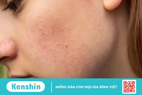 cách trị mụn ẩn tại nhà 1