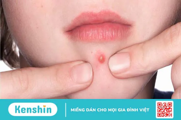 Hướng dẫn cách trị mụn đầu đinh dân gian đơn giản tại nhà