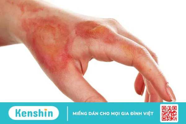 Hướng dẫn mẹ chăm sóc khi con bị bỏng 1