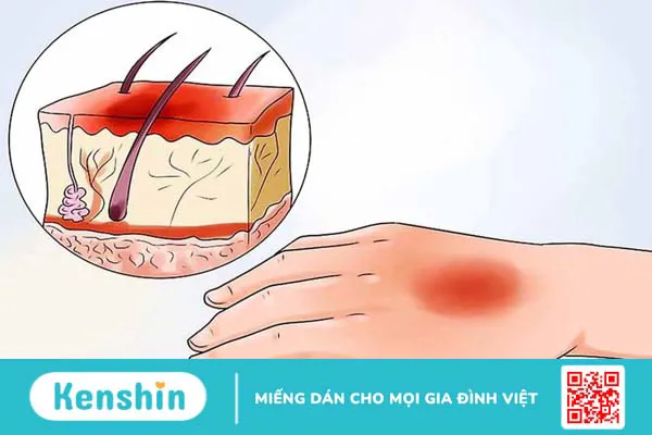 Hướng dẫn mẹ chăm sóc khi con bị bỏng 2