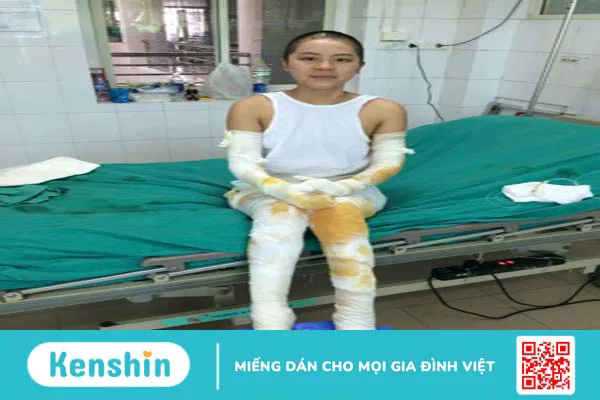 Hướng dẫn mẹ chăm sóc khi con bị bỏng 3