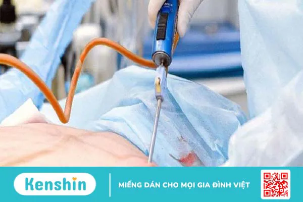 Hút mỡ nách và những điều cần biết về phương pháp này 2