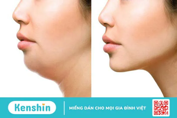 Hút mỡ nọng cằm có nguy hiểm không? Cần chú ý gì? 1