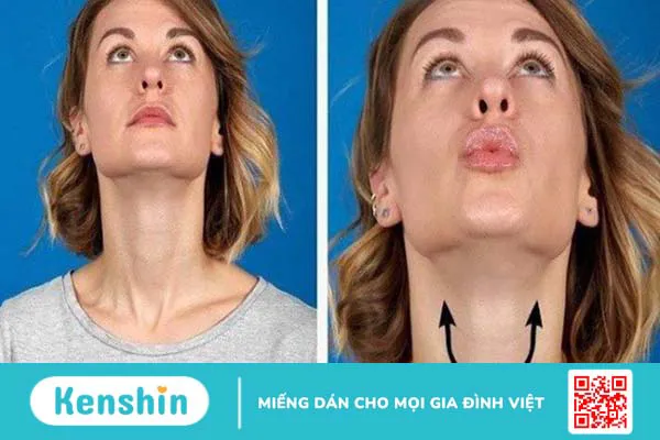 Hút mỡ nọng cằm có nguy hiểm không? Cần chú ý gì? 3