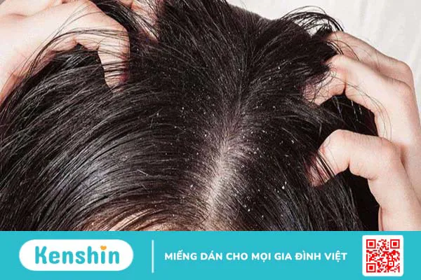 Khắc phục nấm da đầu với dầu gội Nazorel Shampoo Ciclopirox Olamine 1