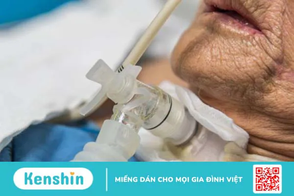 Khai khí quản là gì? Những điều cần biết về khai khí quản 2